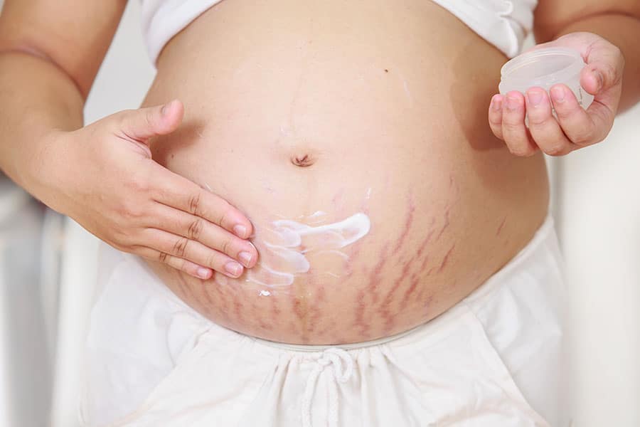Ventre de femme enceinte atteint par des vergetures rosées.