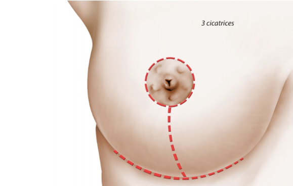 Réduction mammaire - cicatrices