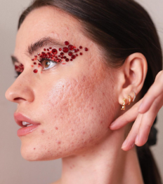 Sofia Grahn, l’influenceuse qui nous apprend à nous aimer avec de l’acné