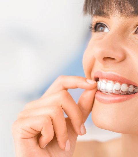 Spark et Invisalign : Les aligneurs dentaires qui révolutionnent l’orthodontie
