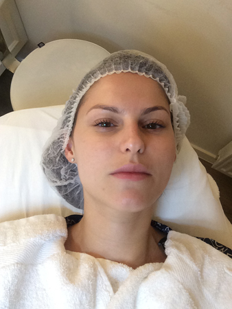 Weinig flatterende mid-treatment selfie