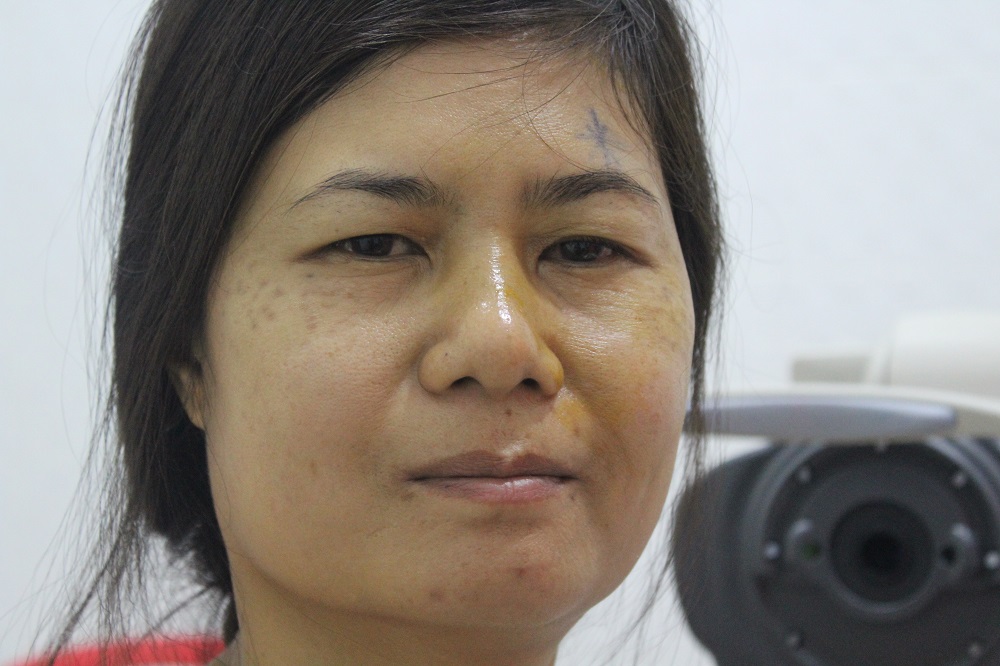 Vrouw na cataractbehandeling.
